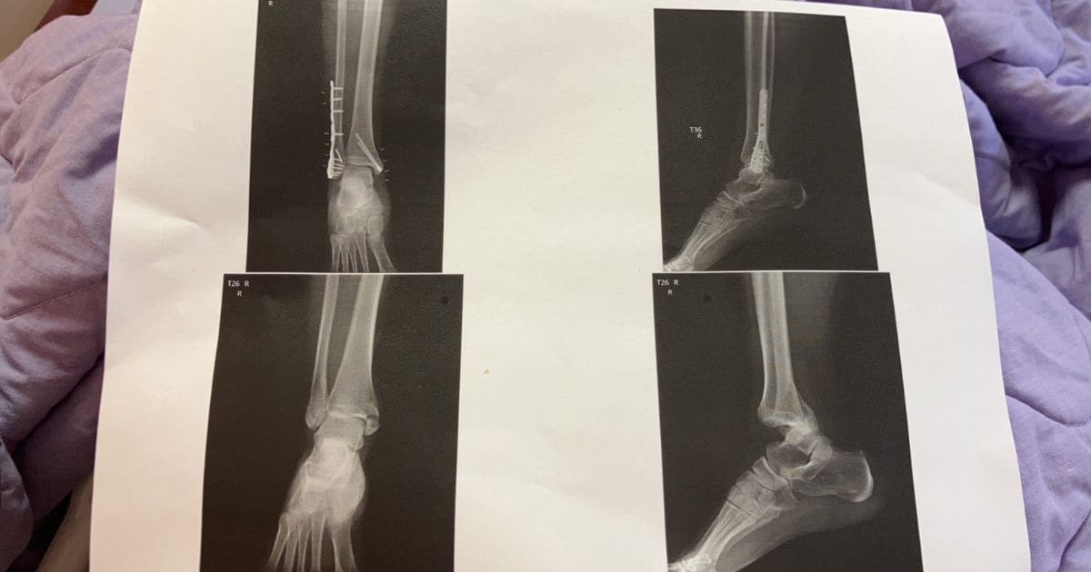 腳踝骨折術前、術後X光片